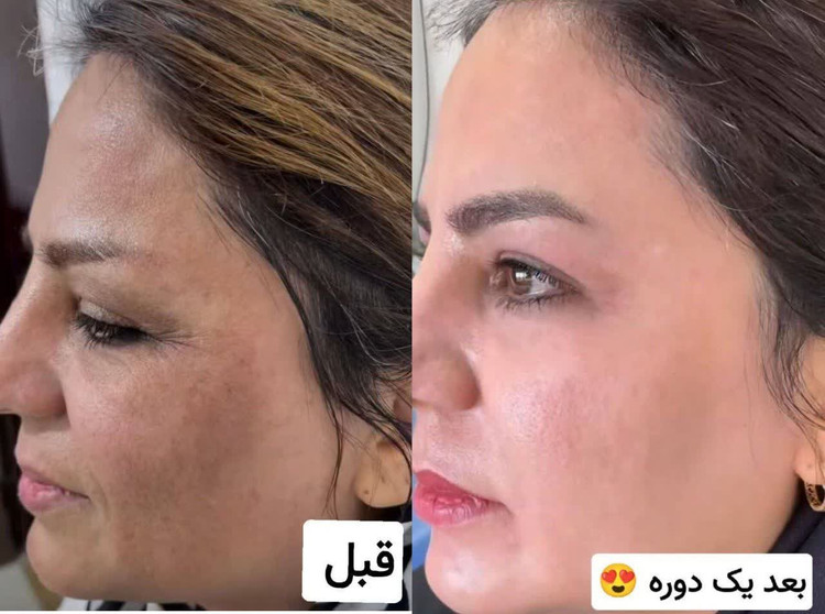 کرم روز گاتیو حاوی هیالورونیک اسید و ابرسانی عمیق پوست--اصل ایتالیا مناسب انواع پوست
