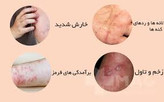 کرم ویتامین e و الوعه ورا برند ویتابلا خارجی درمان بیماری گال دوره دوماهه دوعدد کرم