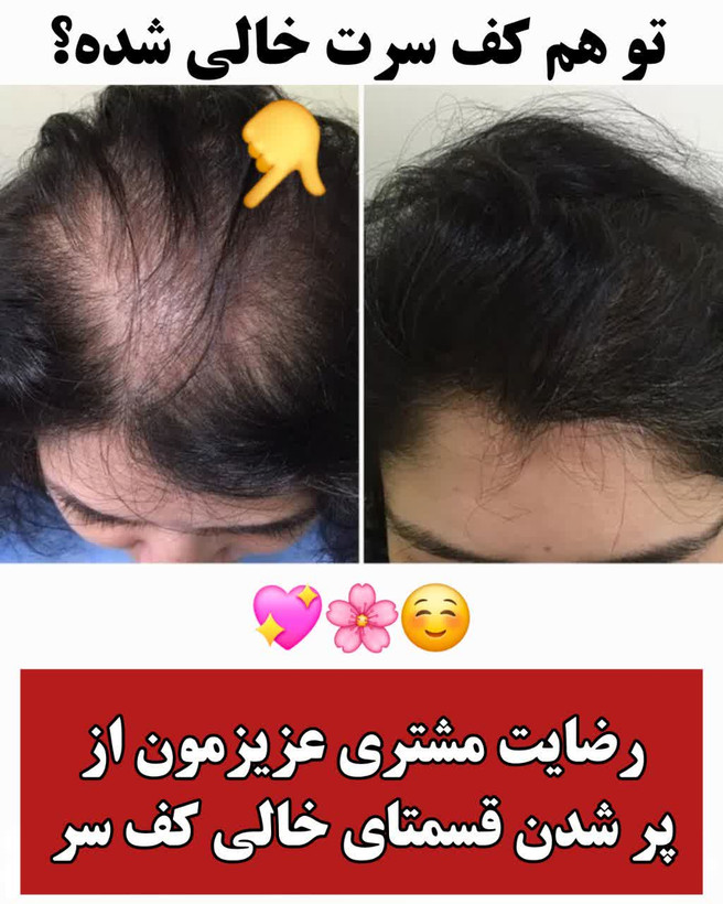 تونیک ضد ریزش و و رویش مجدد مو دوقلو برند اکسونیک-